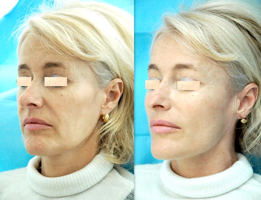 Lifting malaire Lifting malaire