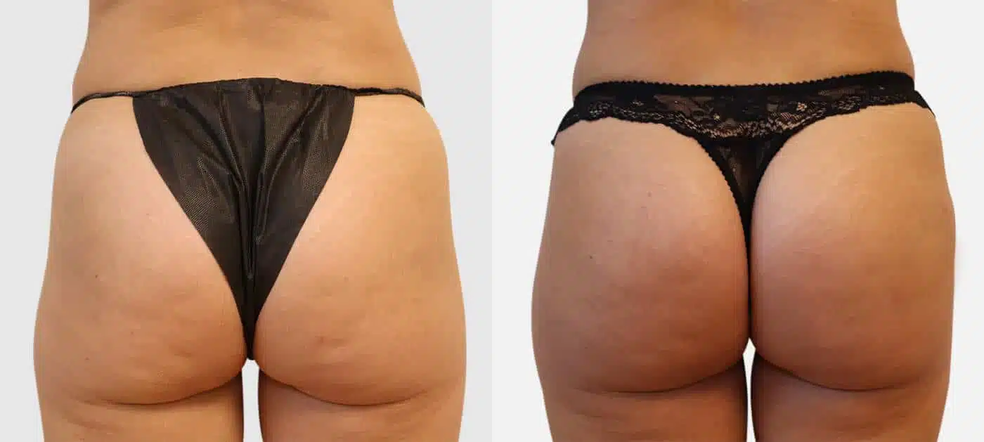 La chirurgie des fesses La chirurgie des fesses