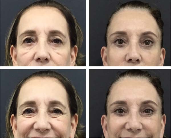 Lifting temporal Lifting temporal