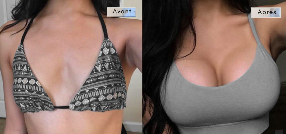 Augmentation-mammaire-avant-et-apres-1 Augmentation Mammaire avec Prothèses