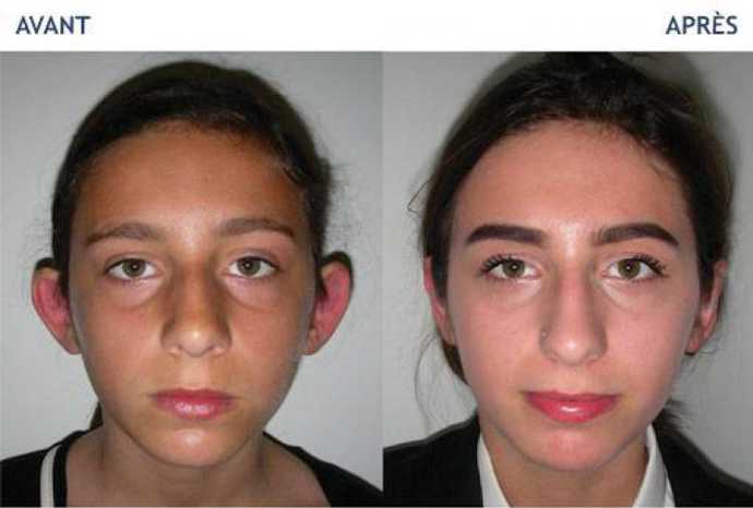 Chirurgie des oreilles décollées