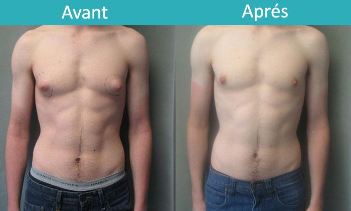 Gynécomastie pour homme