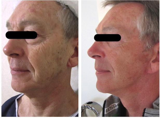 lifting-cervico-facial-homme Lifting cervico-facial