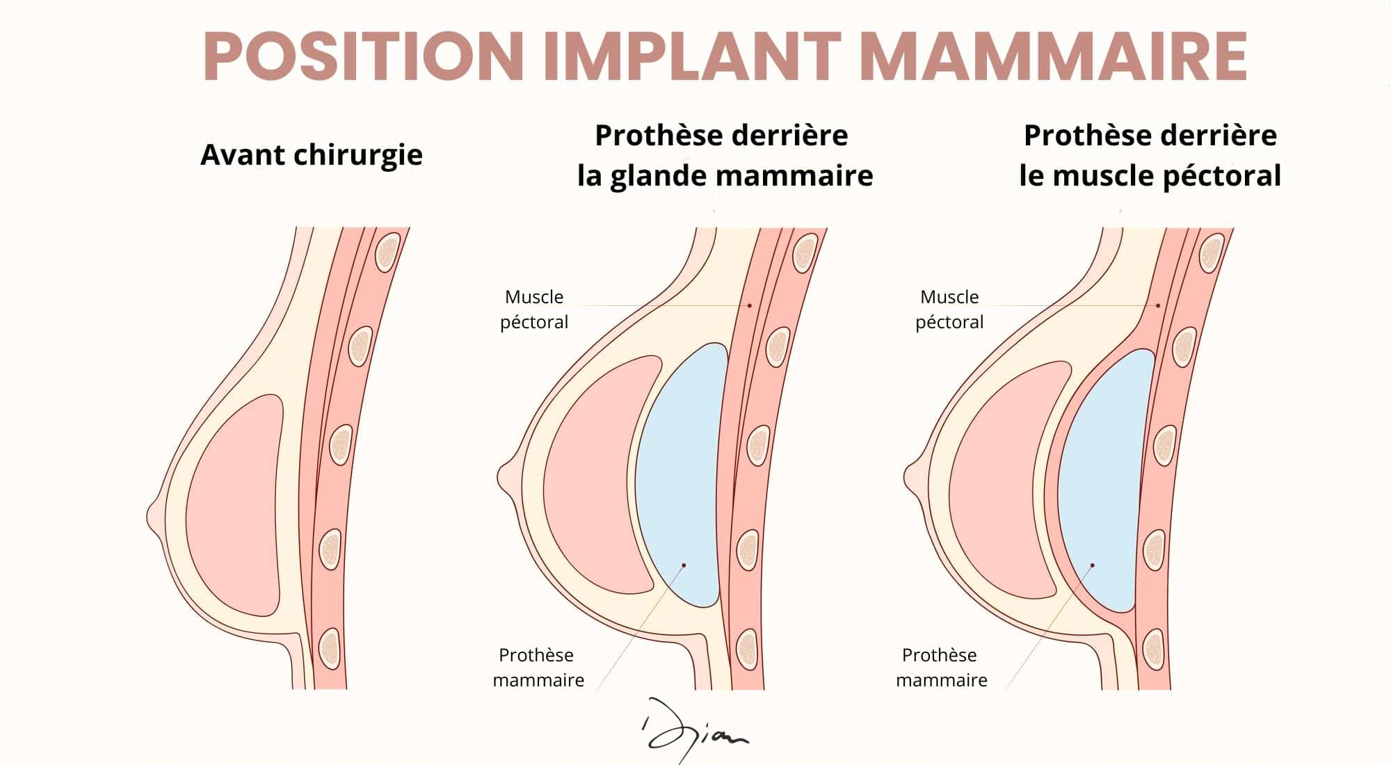Augmentation Mammaire avec Prothèses Augmentation Mammaire avec Prothèses