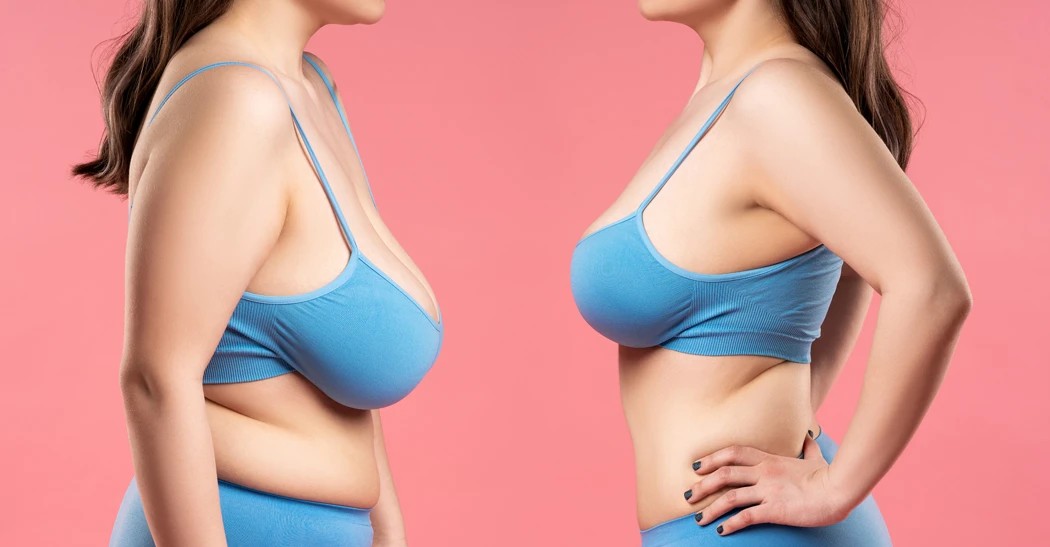 reduction-mammaire La réduction mammaire