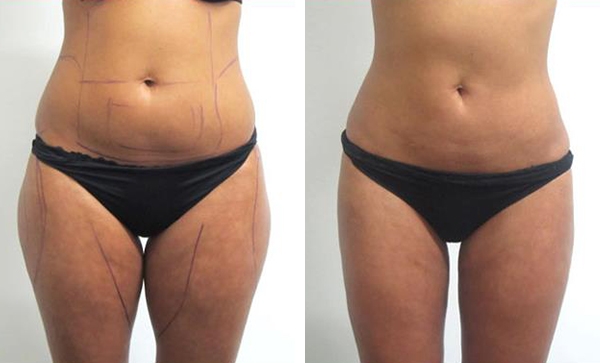 Lifting des Cuisses (Lifting des Membres Inférieurs)