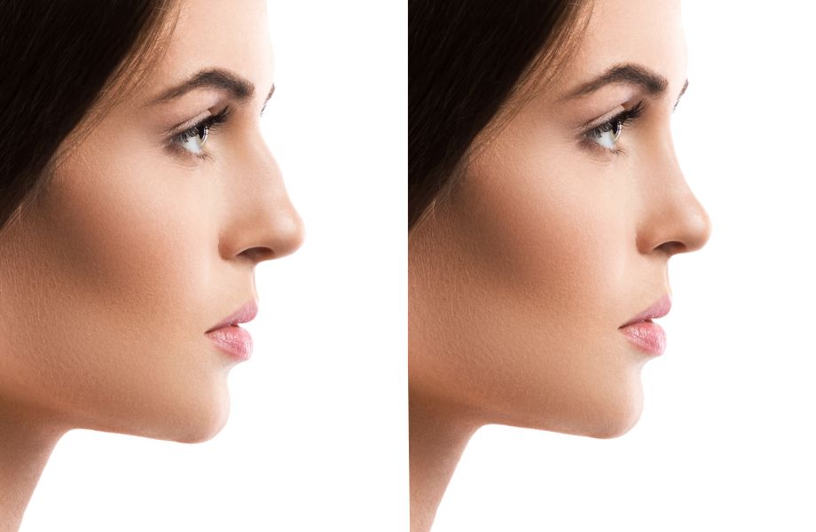 Rhinoplastie esthétique Rhinoplastie esthétique