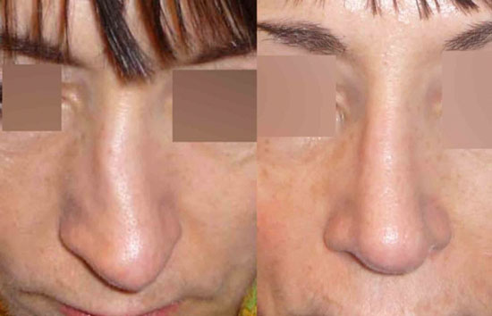 Rhinoplastie + Séptoplastie