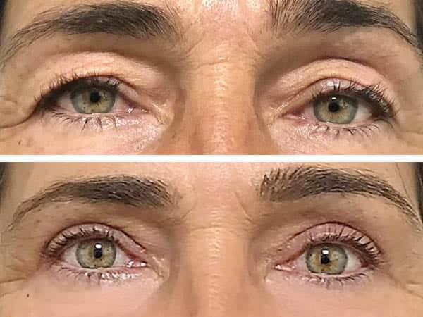 Blépharoplastie supérieure Blépharoplastie supérieure