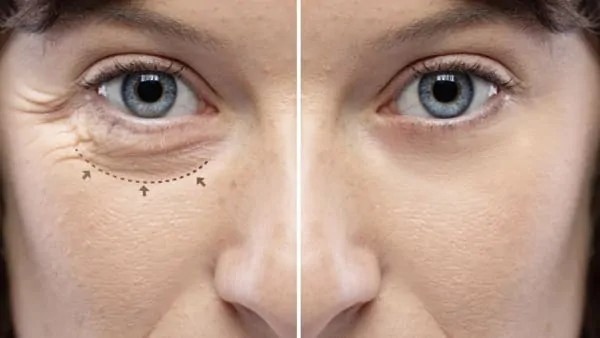 Blépharoplastie inférieure Blépharoplastie inférieure