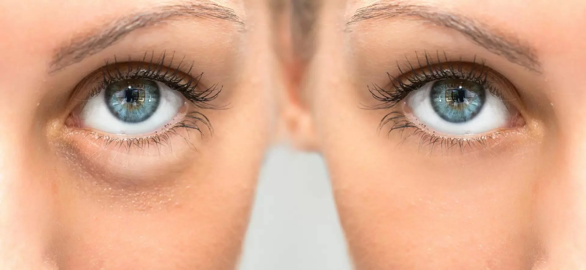 Chirurgie poches sous les yeux Chirurgie poches sous les yeux